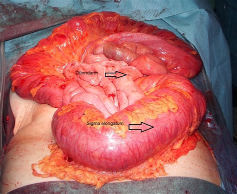 Ileus of the large intestines in enlarged sigmoid ...