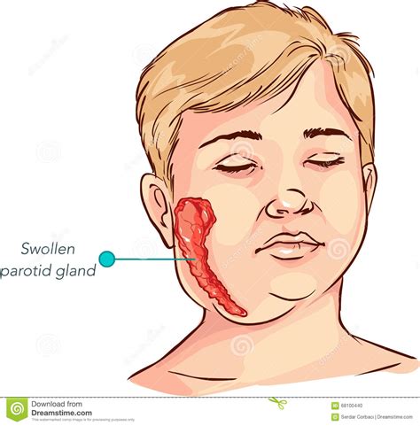 Illustration De Vecteur De Gonflement De Glande Salivaire ...