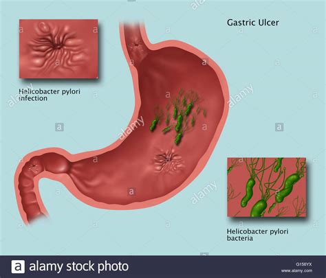Illustration showing the stomach with a gastric ulcer ...
