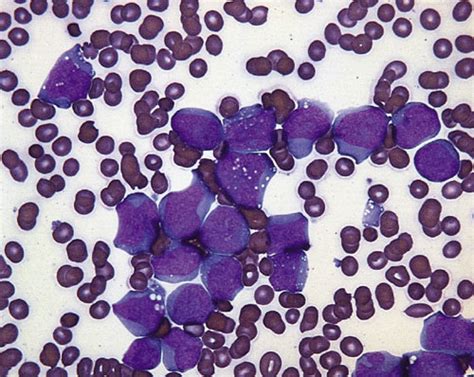 Image: Frotis de sangre periférica en la leucemia mieloide ...