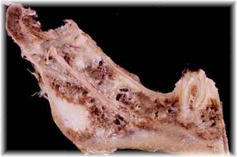 Image Gallery jaw bone cancer