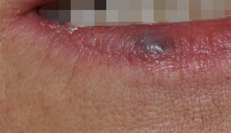 Image Gallery lip melanoma symptoms