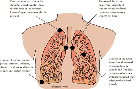 Image Gallery location of lung cancer