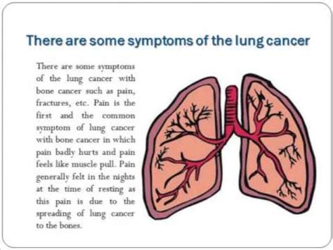 Image Gallery lung cancer metastases spine