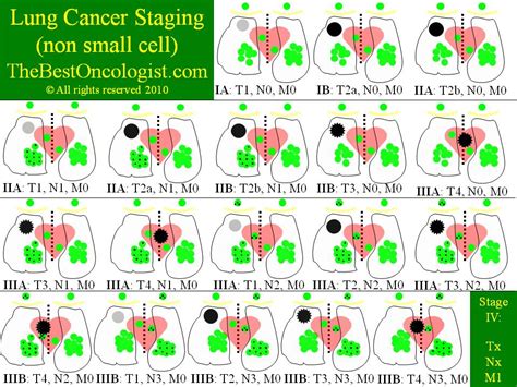 Image Gallery lung tumor staging