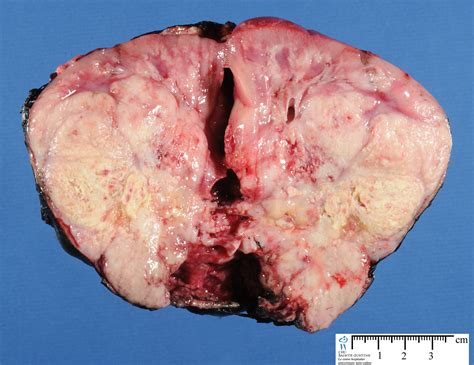 Image Gallery malignant tumor