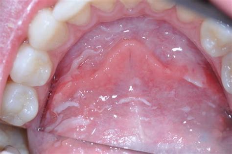 Image Gallery mouth cancer symptoms