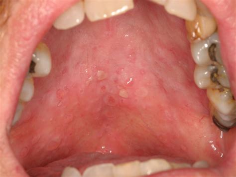 Image Gallery mouth polyps