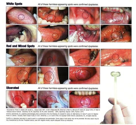 Image Gallery oropharyngeal cancer symptoms