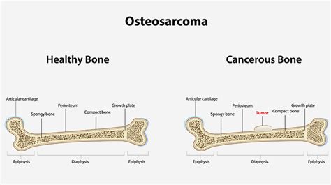 Image Gallery osteosarcoma stage 3