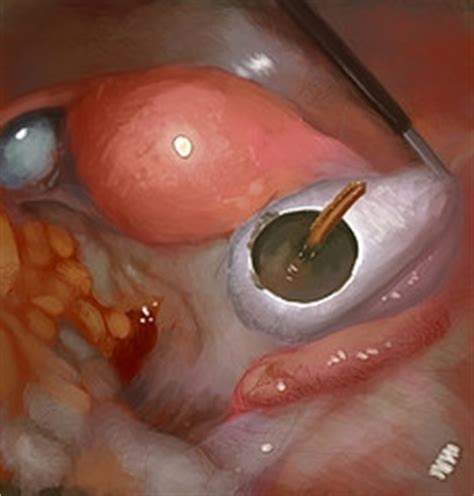 Image Gallery ovarian cyst laparoscopy recovery