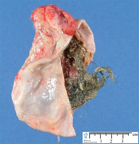 Image Gallery ovarian dermoid tumor