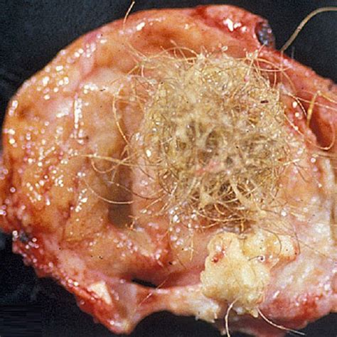 Image Gallery ovarian dermoid tumor
