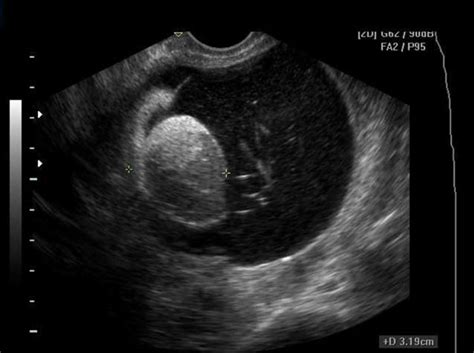 Image Gallery teratoma ultrasound