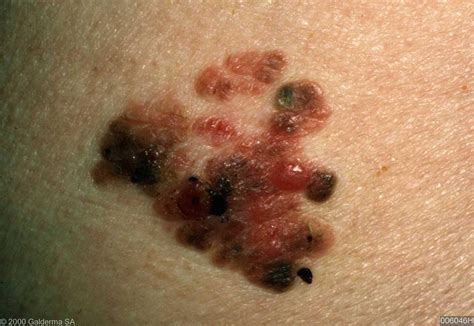 Image Library   malignant melanoma