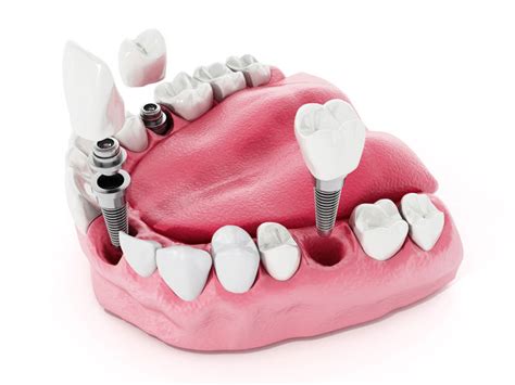 Implantes Dentales en Barcelona ¡Pide Tu Cita Ya!