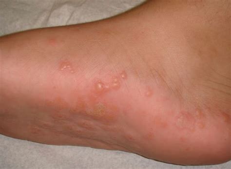 IMSS advierte sobre el contagio de enfermedades en la piel ...