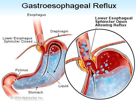 In what cases does the lower esophageal sphincter contract ...