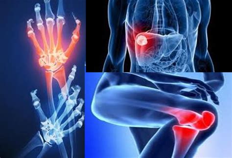 Incapacidad Laboral por Artritis Reumatoide – Abogados ...