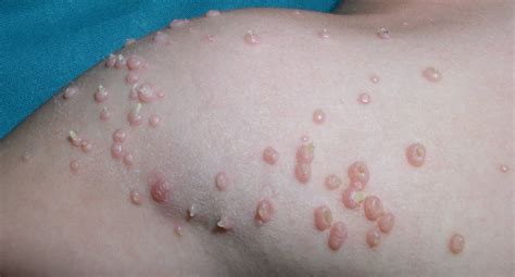 Infecciones de la piel