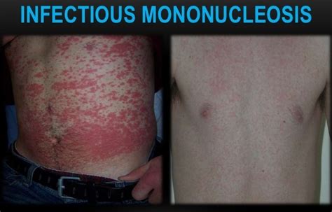 Infectious Mononucleosis | Ask Hematologist | Understand ...