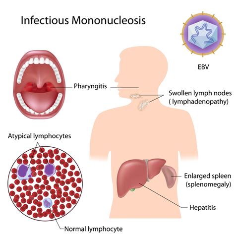 Infectious Mononucleosis   Net Health Book