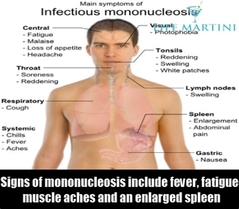 Infectious Mononucleosis Treatment Mono Symptoms Causes ...