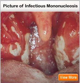 Infectious Mononucleosis Treatment, Mono Symptoms & Causes