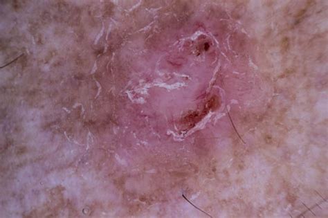 Infiltrating Basal Cell Carcinoma Pictures