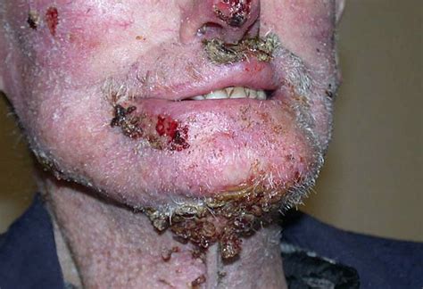 infiltrative basal cell carcinoma   pictures, photos