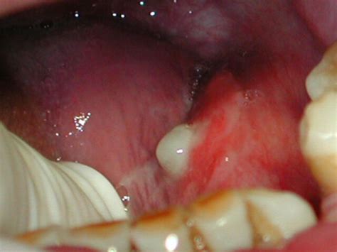Inflamación de las glándulas salivales | Patologia Oral ...