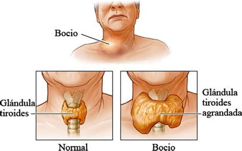 Inflamación de Tiroides: Síntomas de Tiroides inflamada ...