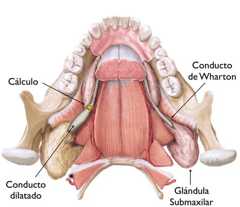 Inflamación glándula salival, sialolitiasis   Glándula ...