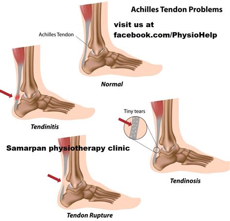 inflamed achilles tendon | Search Results | Million Gallery