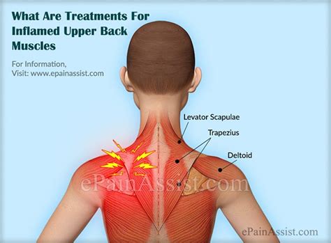 Inflamed Upper Back Muscles: Treatment, Causes, Symptoms