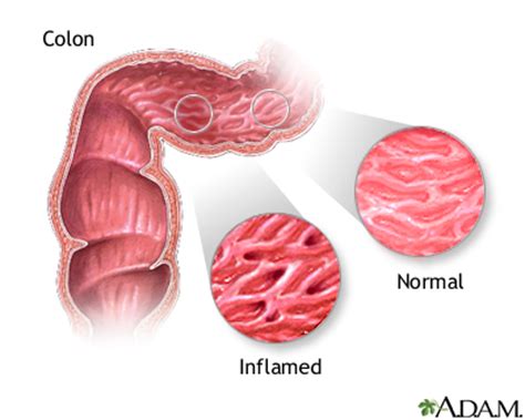 Inflammatory bowel disease   series: MedlinePlus Medical ...