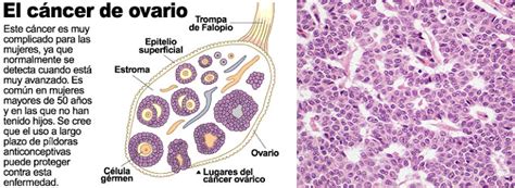 Información sobre el cáncer de ovarios   Cáncer ovárico ...