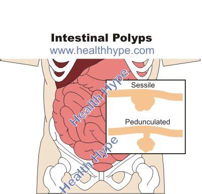 Intestinal Polyps  Types of Growths in Small Intestine and ...