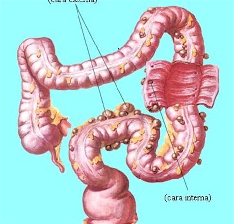 intestino grueso | Salud y Enfermedad