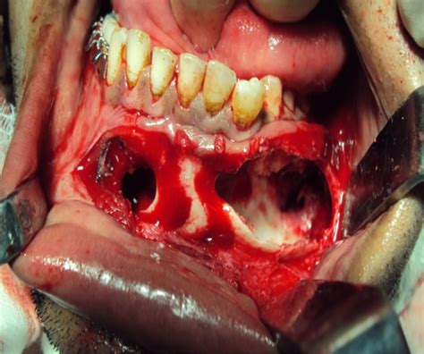Intra osseous dermoid cyst of mandible—A rare case report