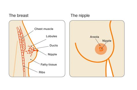 Invasive ductal breast cancer