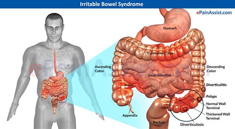 Irritable Bowel Syndrome  IBS : Treatment, Symptoms, Signs ...