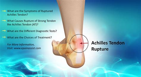 Is Achilles Tendon Rupture a Common Injury|Causes ...