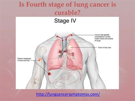 Is fourth stage of lung cancer is curable