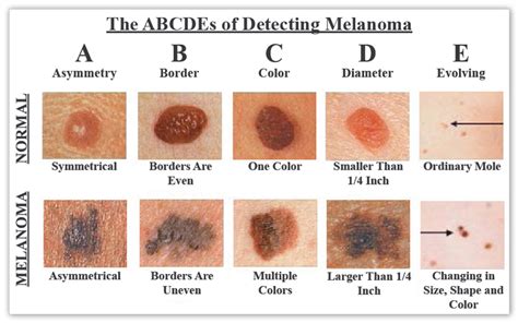 Is It Cancer? Know Your Skin Cancer ABCs. It Might Save ...