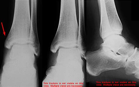 Isolated medial malleolus fracture