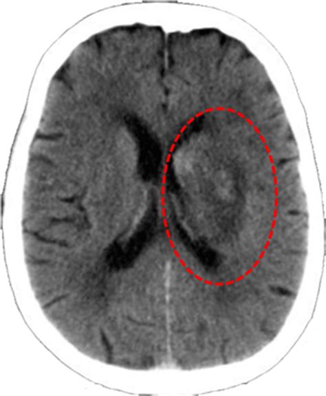 Isquemia Cerebral – Clínica Neuros