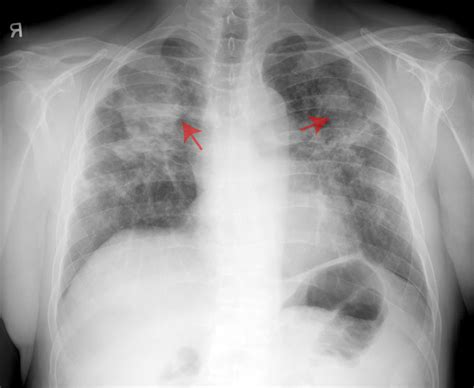 Johns Hopkins medical unit rarely finds black lung ...