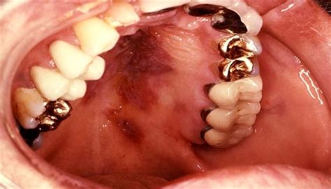 Kaposi sarcoma of the mouth