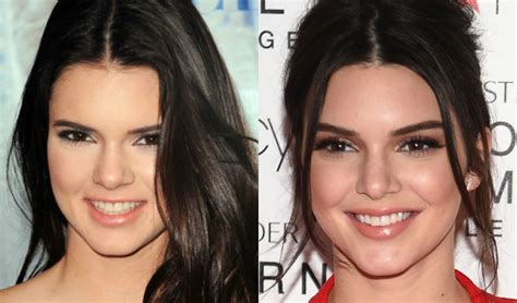 Kendall Jenner Plastic Surgery  Nose Job, Eyebrow Lift ...